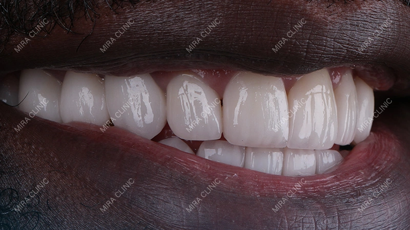 The Result of Dental implant